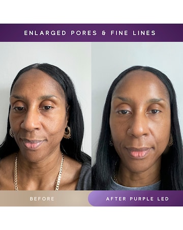 Sensse Elite LED Face Mask - 8 Light