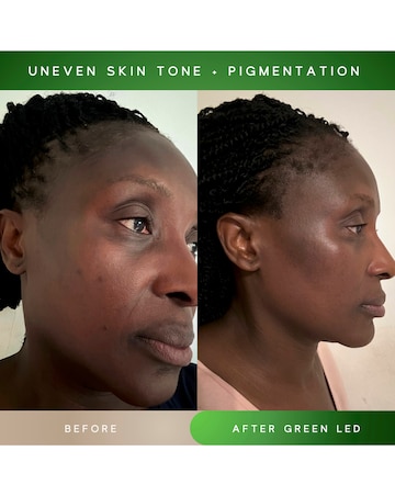 Sensse Elite LED Face Mask - 8 Light