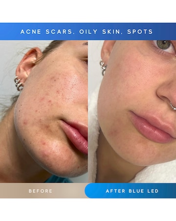 Sensse Elite LED Face Mask - 8 Light