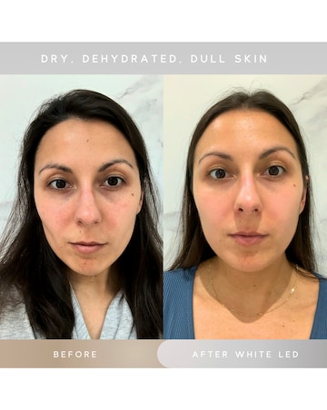 Sensse Elite LED Face Mask - 8 Light