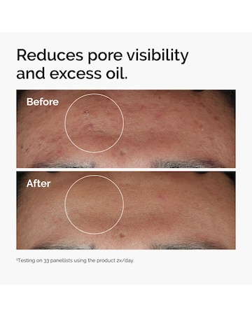 Niacinamide 10% + Zinc 1% High-Strength Vitamin and Mineral Blemish Formula